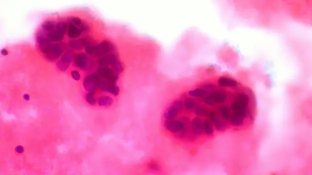 Metastatic Breast Cancer in Pleural Fluid